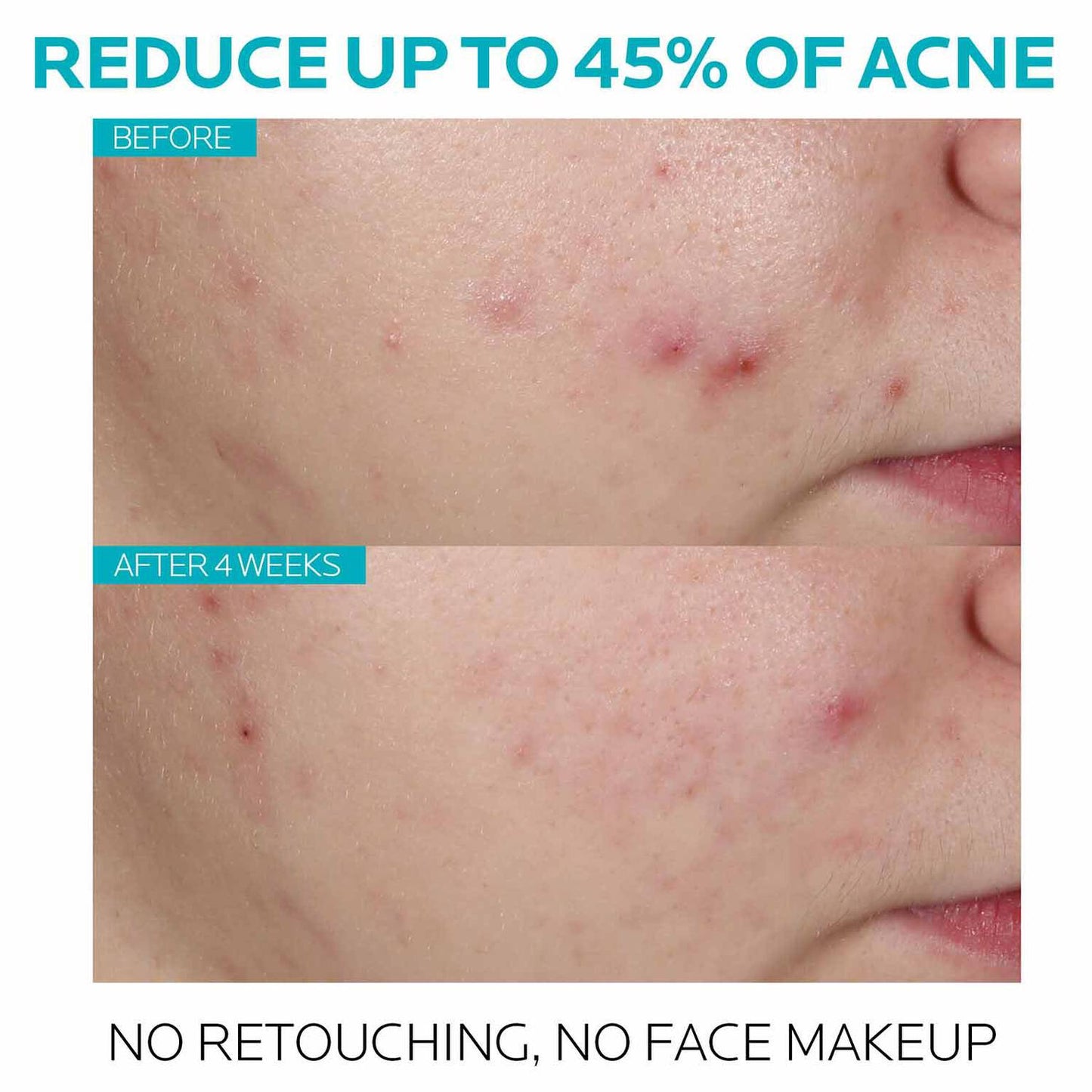 effaclar-salicylic-acid-acne-treatment-serum-x7 7_EffaclarSerum_After-45-days.jpg
