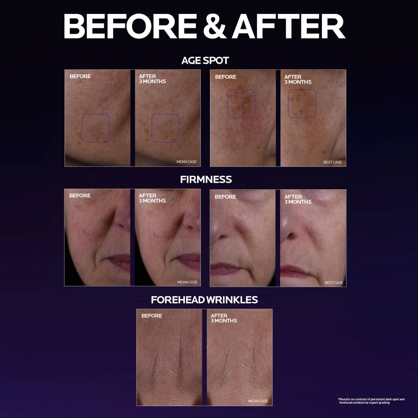 mela-b3-double-dose-discoloration-treatment-with-melasyltm-b1 MelaB3_DD_BTF_BeforeAfter_1500x1500_5.jpg