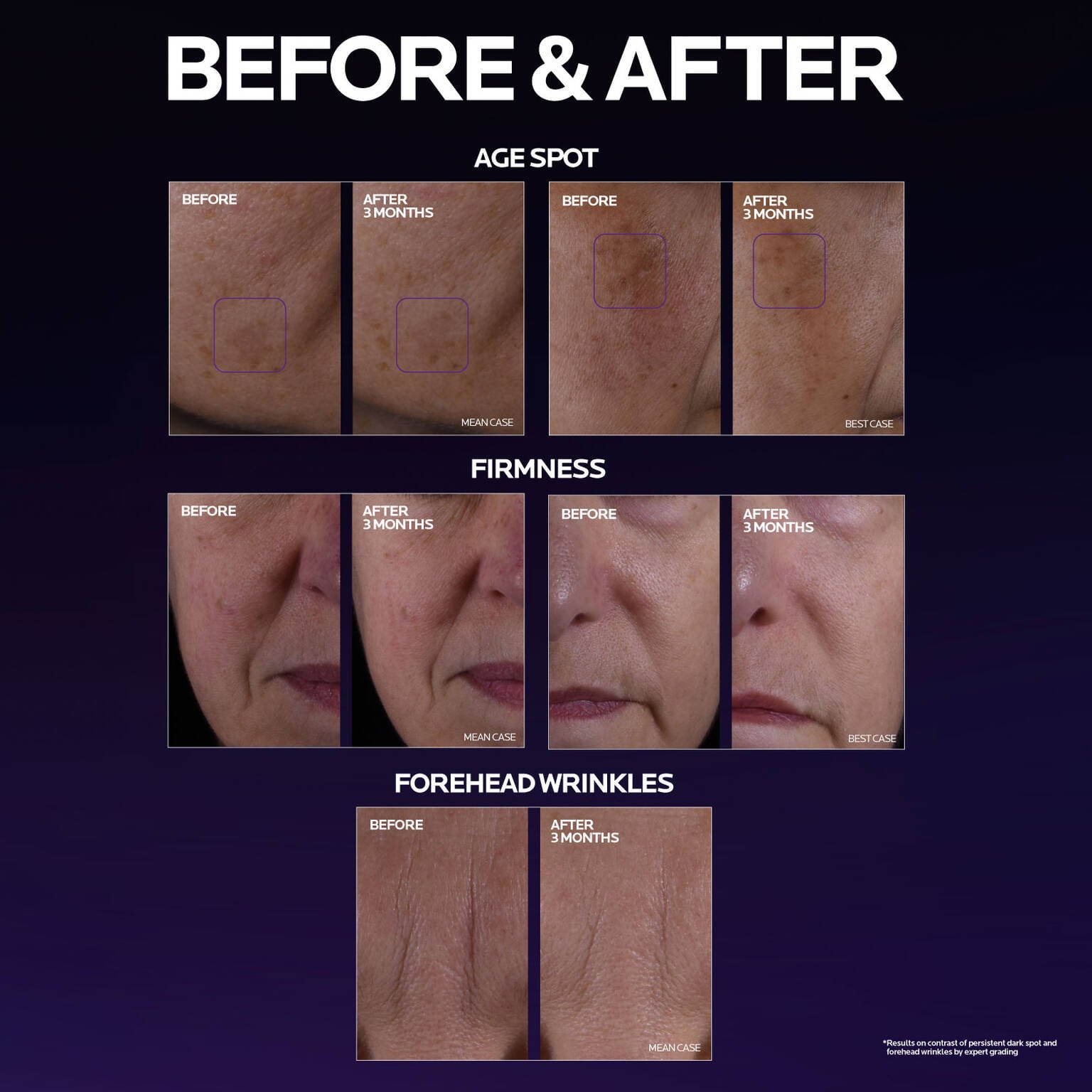 mela-b3-double-dose-discoloration-treatment-with-melasyltm-b1 MelaB3_DD_BTF_BeforeAfter_1500x1500_5.jpg